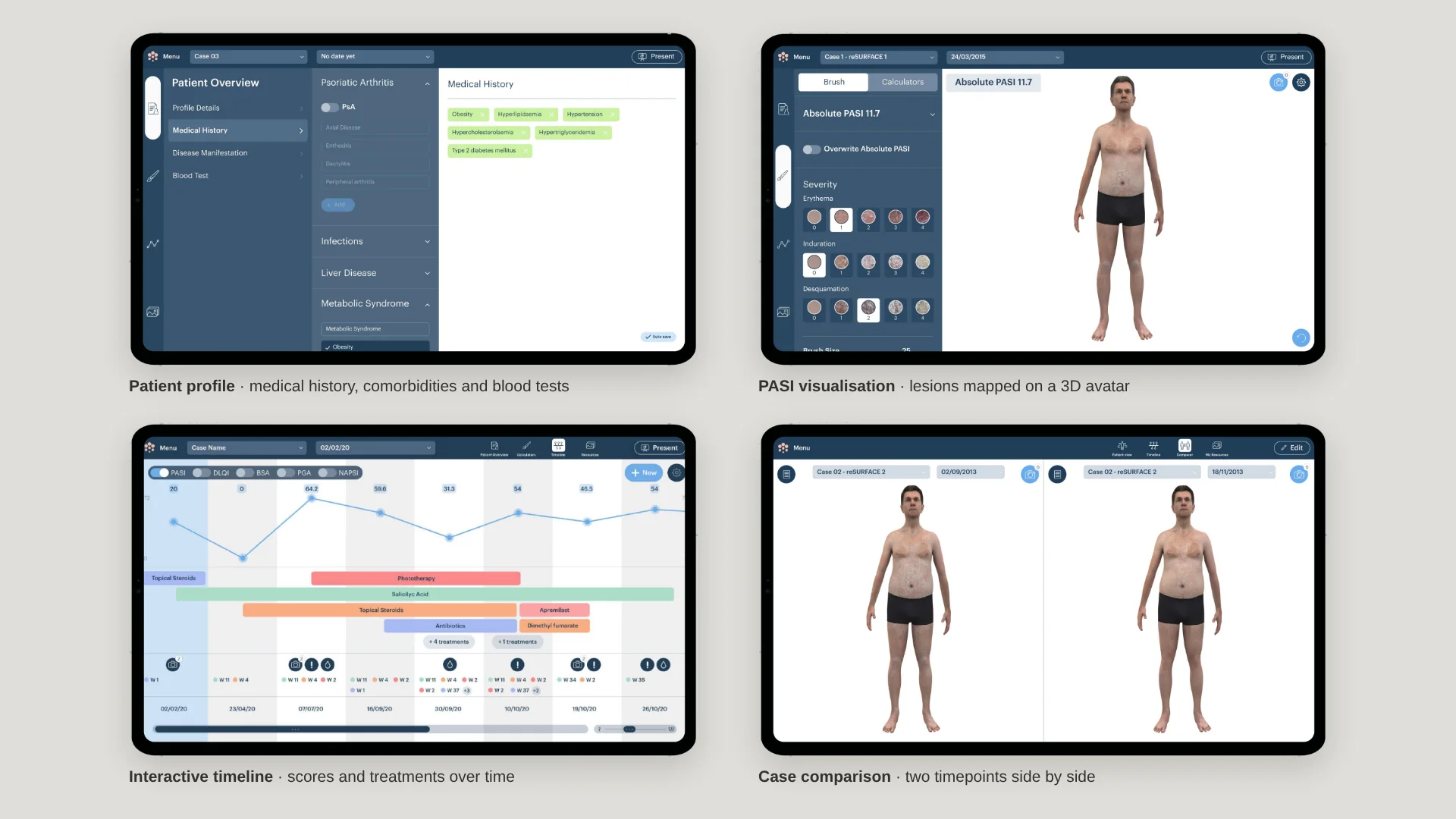 Four SAM features: patient profile, PASI visualisation, interactive timeline and case comparison